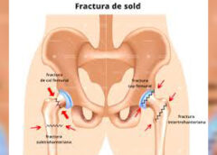 FRACTURILE DE ȘOLD, O URGENȚĂ LA VÂRSTNICI
