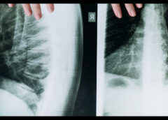 VIZITA LA MEDICUL ORTOPED, ESENȚIALĂ